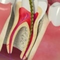 Who usually does root canals?