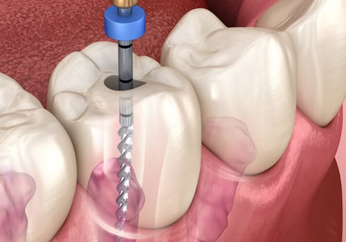 Should a regular dentist do a root canal?