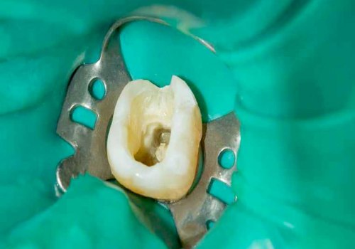 Are root canals a safe and effective treatment option for dental infections?
