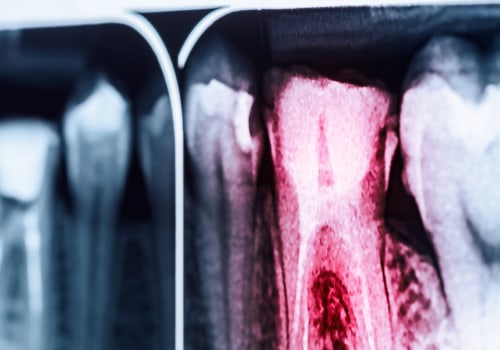 Who decides if you need a root canal?