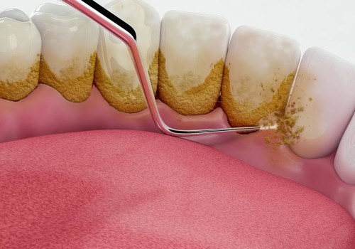 Why dentist polish teeth?