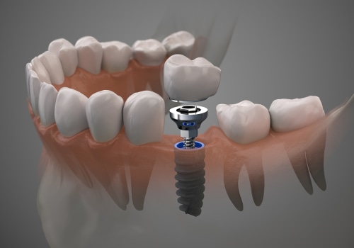 Choosing the Right Dentist for Dental Implants