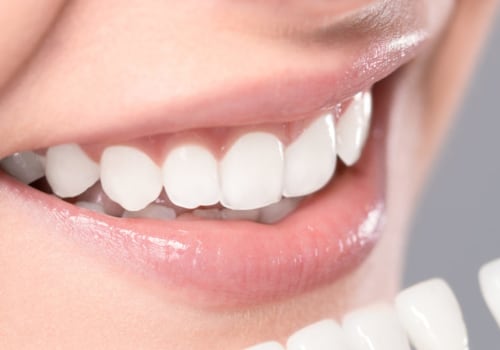 What Factors Affect Teeth Whitening?