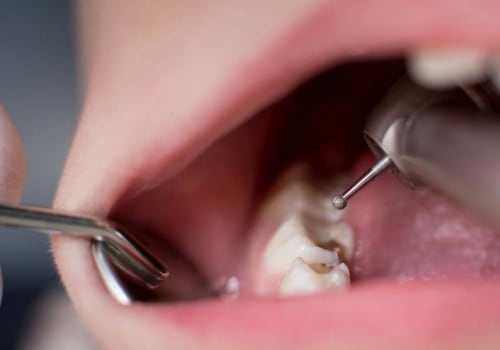 How dentist fix cavities?