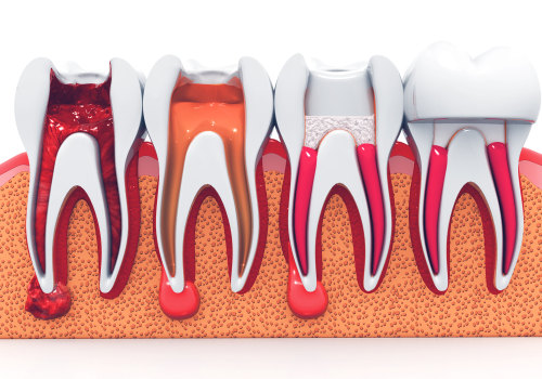 How does a dentist confirm you need a root canal?
