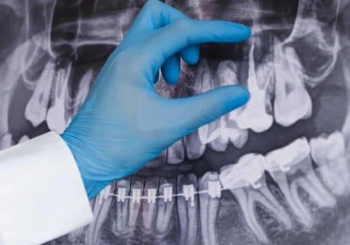 Why don t regular dentists do root canals?